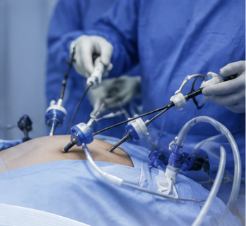 Close-up of laparoscopic surgical instruments in use during keyhole surgery